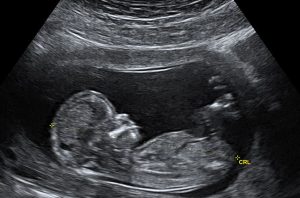 Ultrasound